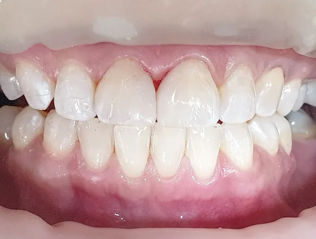 After: ฟันหน้ามีช่องว่างไม่สวยงาม ทำการอุดปิดร่องฟันด้วยคอมโพสิตเรซิน