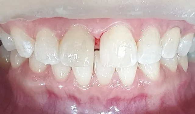 Before: ฟันหน้ามีช่องว่างไม่สวยงาม ทำการอุดปิดร่องฟันด้วยคอมโพสิตเรซิน
