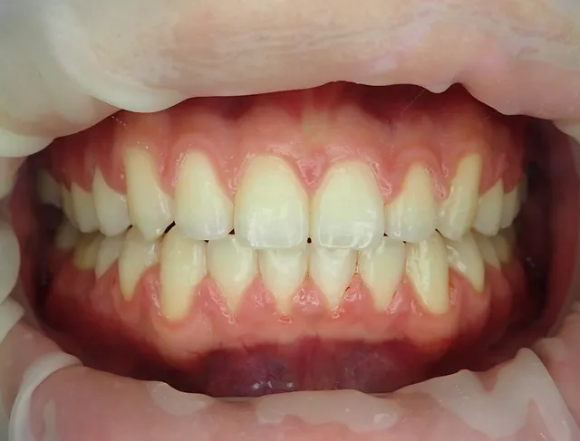 After: ฟันหน้ามีช่องว่างไม่สวยงาม ทำการอุดปิดร่องฟันด้วยคอมโพสิตเรซิน