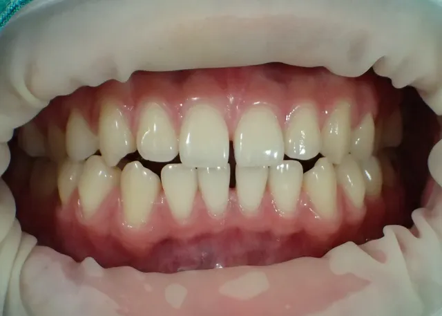 Before: ฟันหน้ามีช่องว่างไม่สวยงาม ทำการอุดปิดร่องฟันด้วยคอมโพสิตเรซิน
