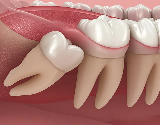 ศัลยกรรมช่องปาก ผ่าฟันคุด ผ่าตัดขากรรไกร แก้ไขปัญหาช่องปากและฟันที่ซับซ้อน?