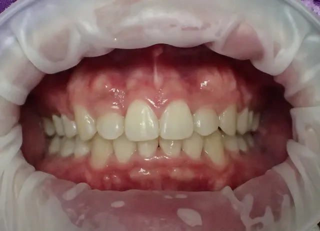 After: ฟันซ้อนเก เรียงตัวไม่สวยงาม แก้ไขด้วยการจัดฟัน