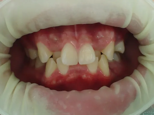 Before: ฟันซ้อนเก เรียงตัวไม่สวยงาม แก้ไขด้วยการจัดฟัน