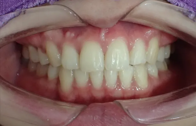 After: ฟันซ้อนเก เรียงตัวไม่สวยงาม แก้ไขด้วยการจัดฟัน