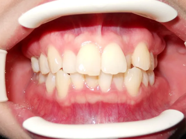 Before: ฟันซ้อนเก เรียงตัวไม่สวยงาม แก้ไขด้วยการจัดฟัน