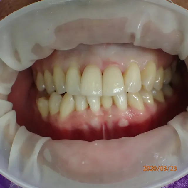 After: ผิวหน้าฟันบิดและเรียงตัว ผันบิ่น ไม่สวยงาม แก้ไขโดยเคลือบผิวฟันด้วยวีเนียร์