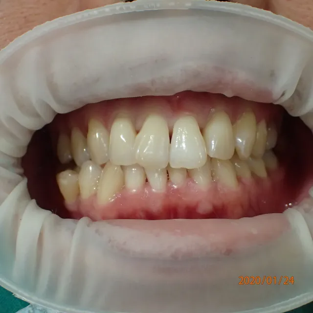 Before: ผิวหน้าฟันบิดและเรียงตัว ผันบิ่น ไม่สวยงาม แก้ไขโดยเคลือบผิวฟันด้วยวีเนียร์