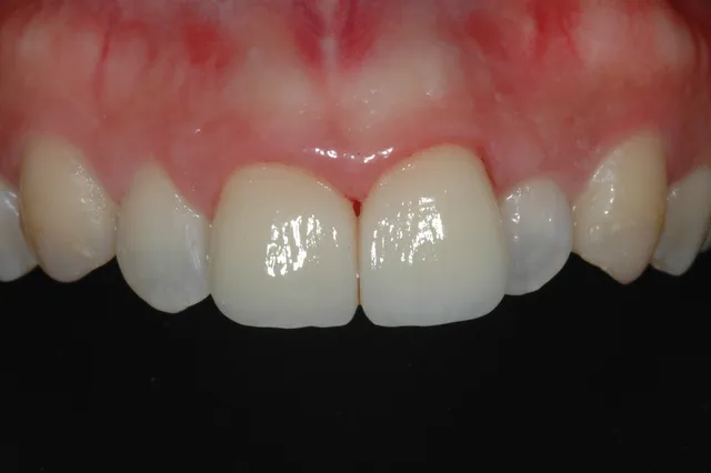 After: ผิวหน้าฟันแตกเป็นหลุม มีสีดำ ไม่สวยงาม เคลือบผิวฟันด้วยวีเนียร์