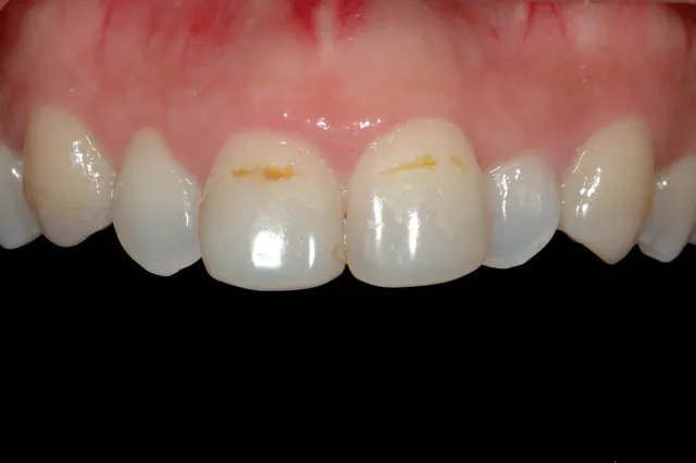 Before: ผิวหน้าฟันแตกเป็นหลุม มีสีดำ ไม่สวยงาม เคลือบผิวฟันด้วยวีเนียร์